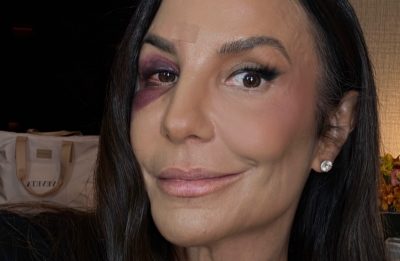Ivete Sangalo revela os bastidores do acidente que resultou em fraturas faciais